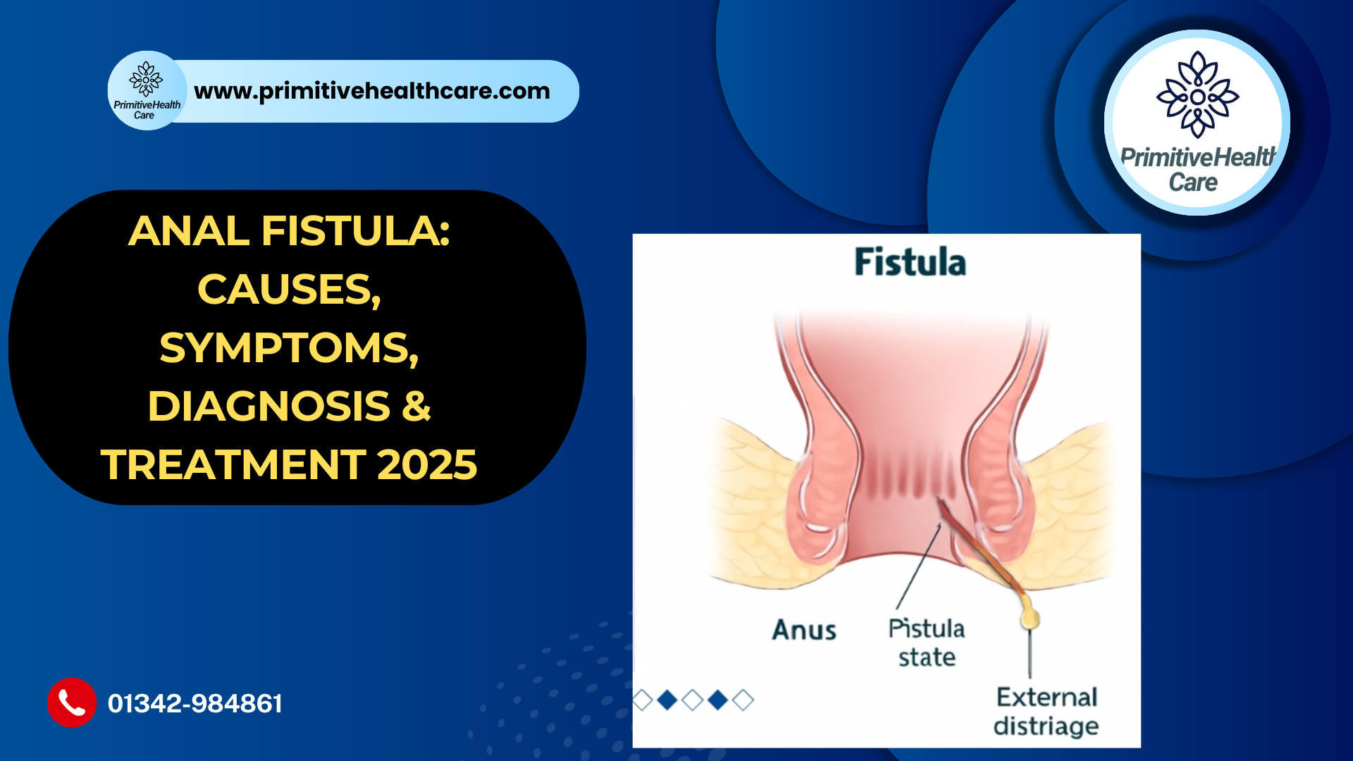 Anal Fistula: Causes, Symptoms, Diagnosis & Treatment 2025